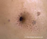 Dry core hole